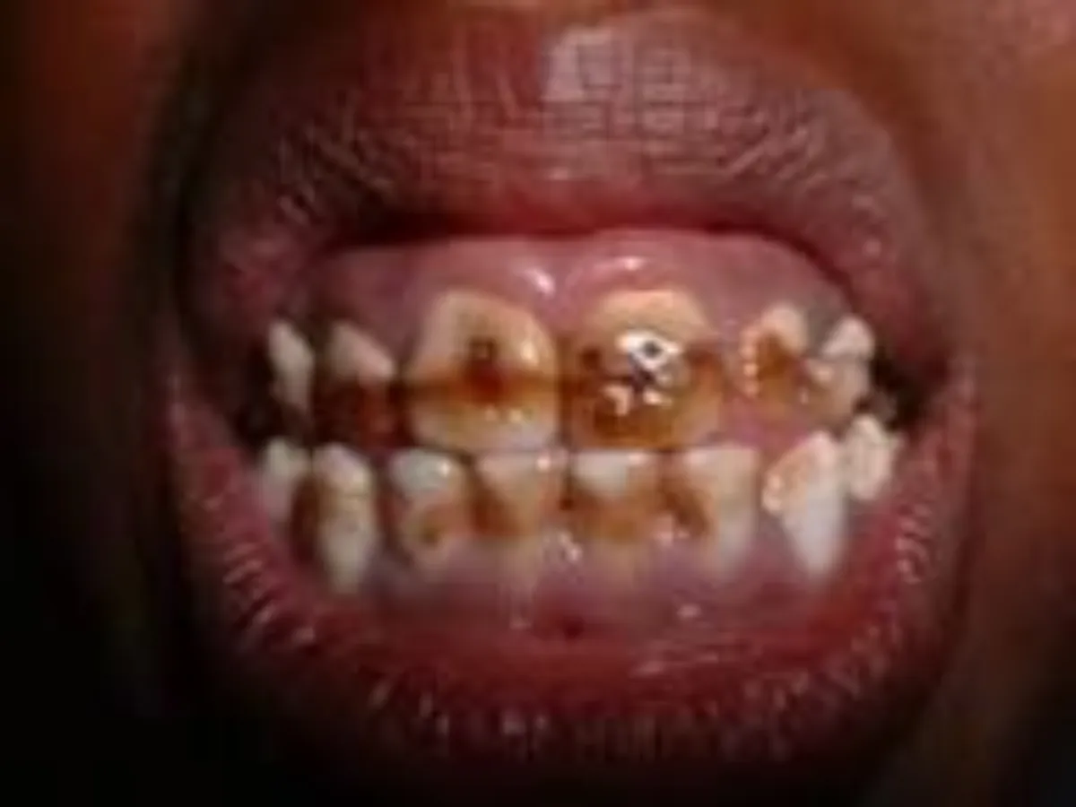 Brown teeth  due to High fluoride levels in drinking water